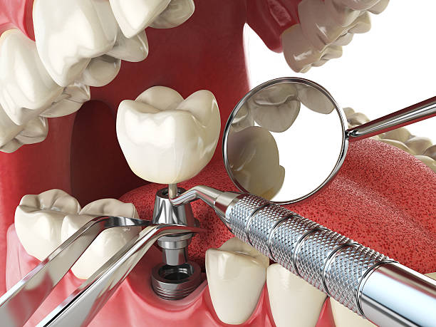 Best Emergency Tooth Extraction in Sidney, MT
